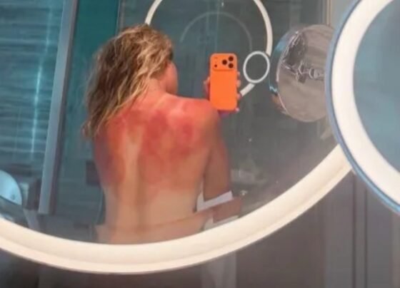 Renata Zarazúa Queimaduras