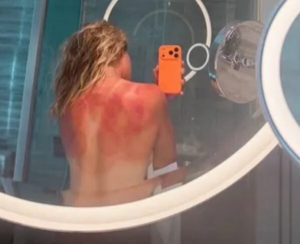 Renata Zarazúa Queimaduras