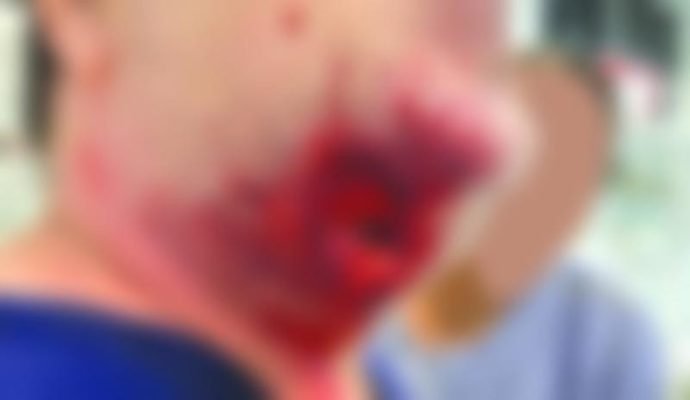 Mulher sofre ferimento grave após ser mordida pelo marido em